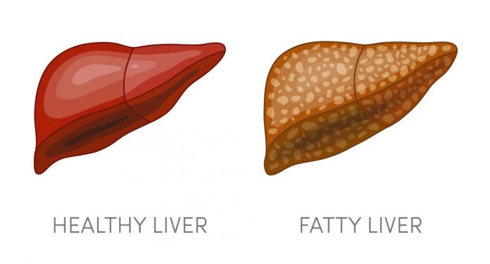 natural help for non-alcoholic fatty liver disease nafld